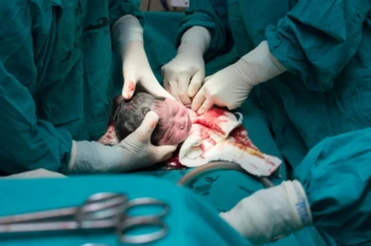 Cesarean Delivery