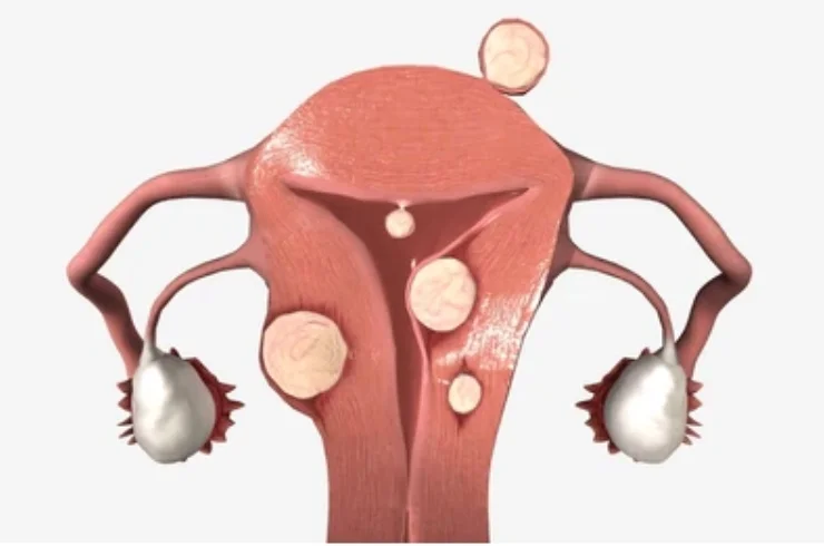 Fibroid & Menopausal Issues